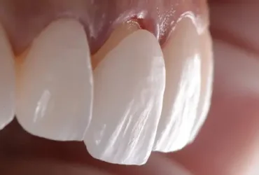 آیا لمینت باعث پوسیدگی دندان میشود